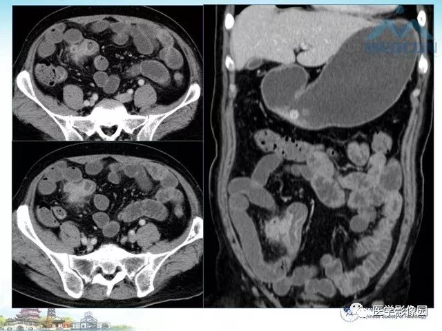 小肠ct分段解剖图图片