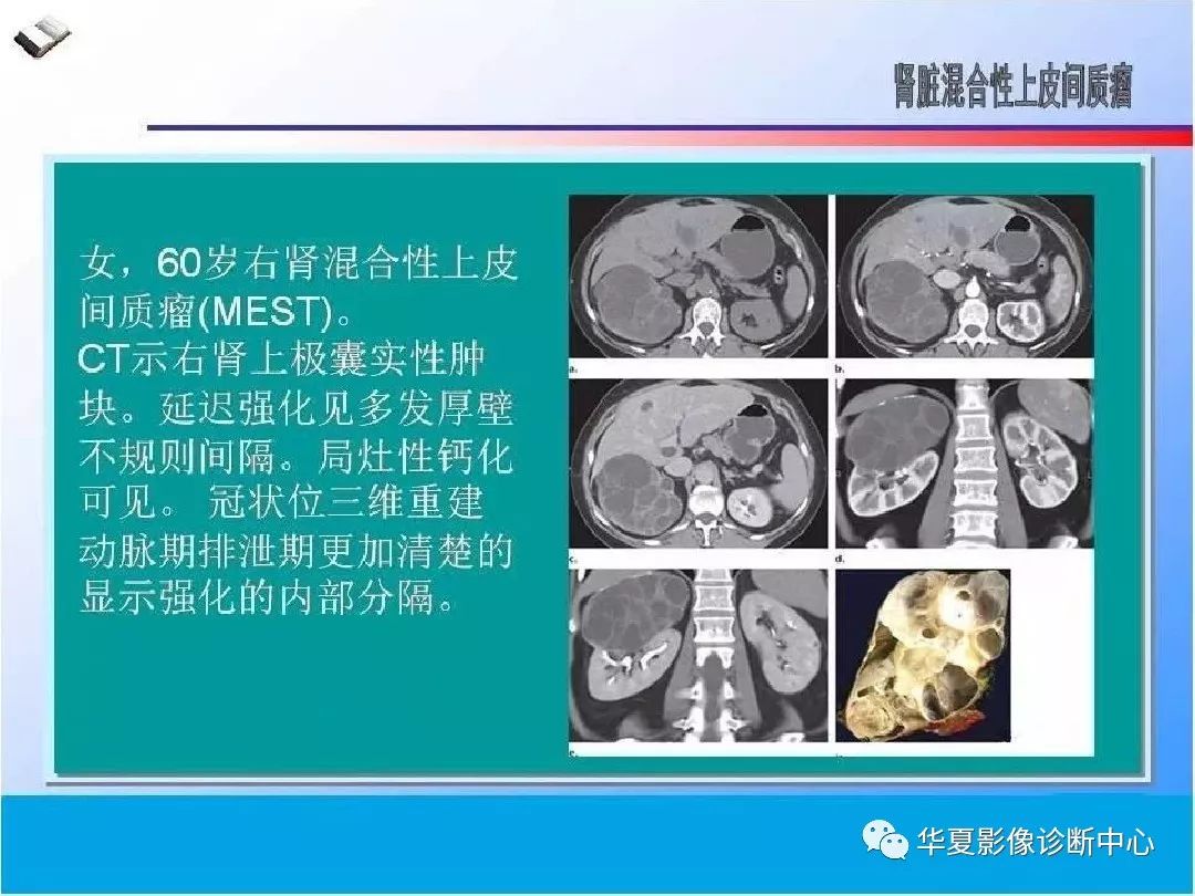 肾脏囊性病变的ct诊断与鉴别诊断