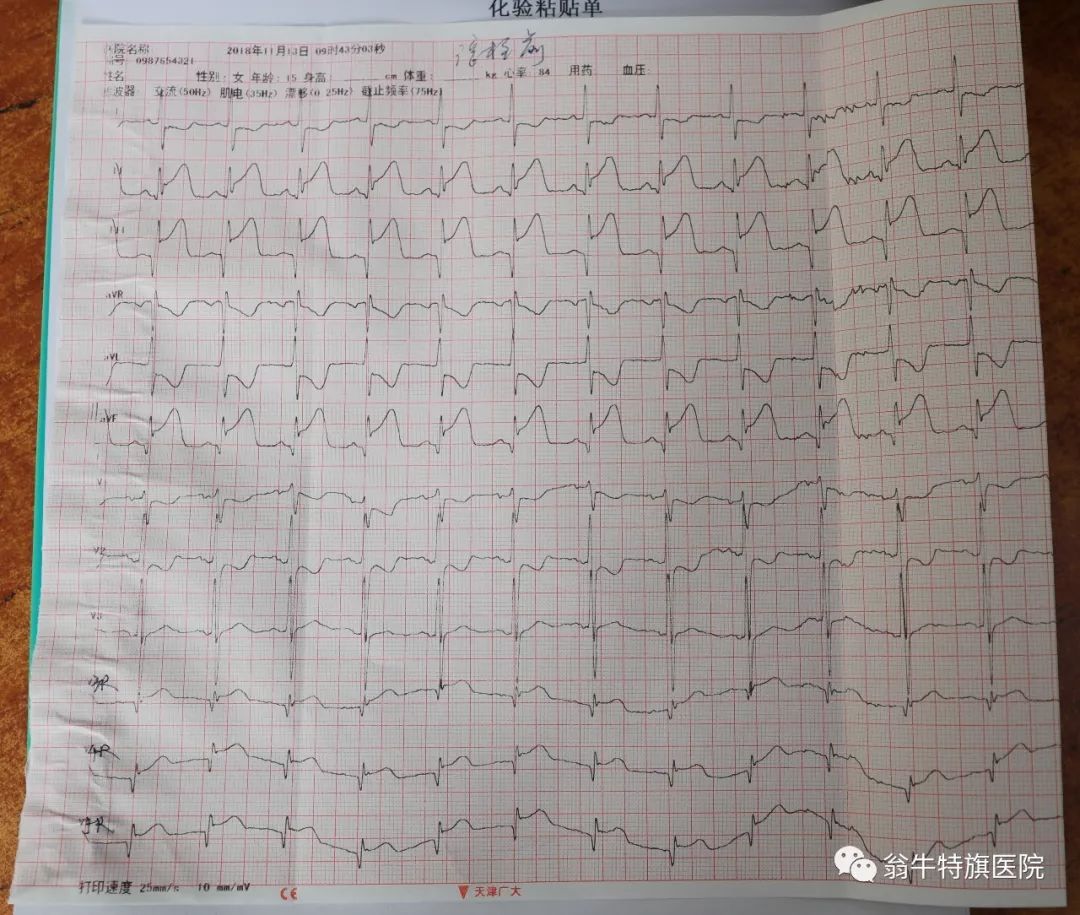 翁牛特旗医院成功抢救一例心肌梗死患者