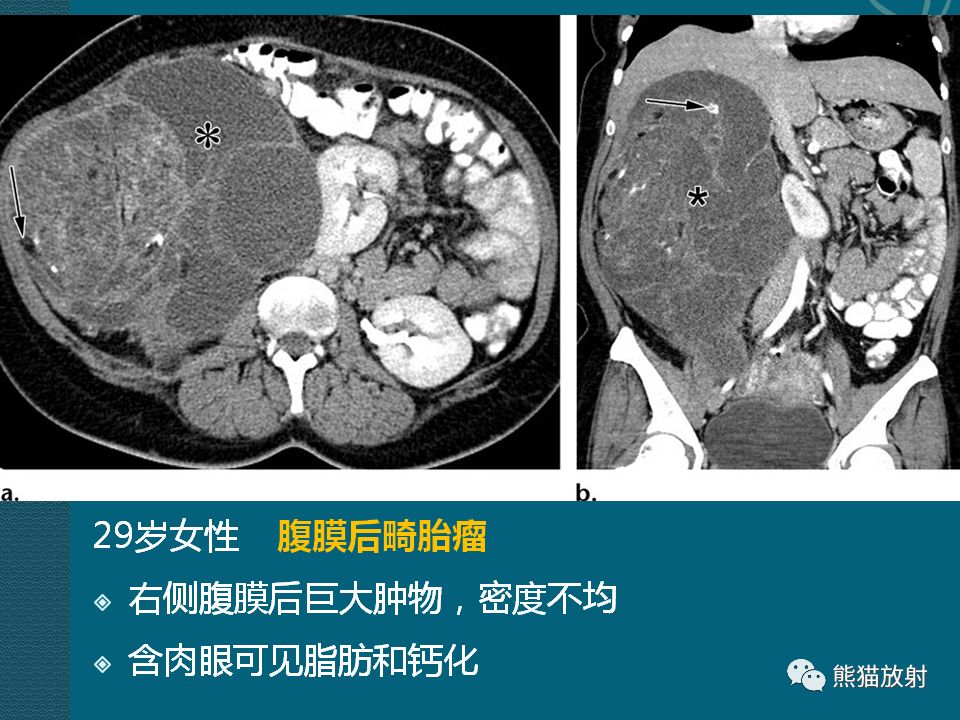 腹膜后平滑肌肉瘤图片