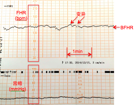 胎心监护图解析图片