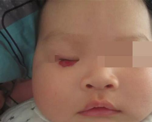 宝宝眼部出现血管瘤怎么办?