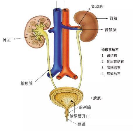 输尿管结石结构示意图图片