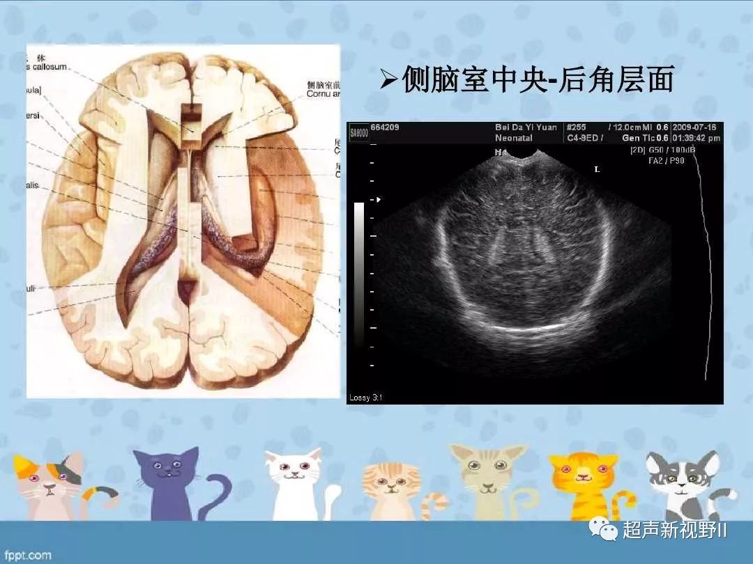 【超声微课堂】新生儿颅脑超声检查规范