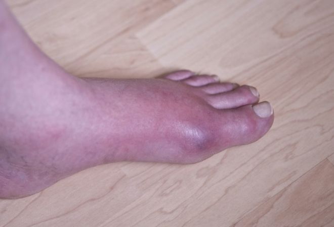 此外,还有一个特征,大多数是从大脚趾,跖趾关节,开始红肿热痛