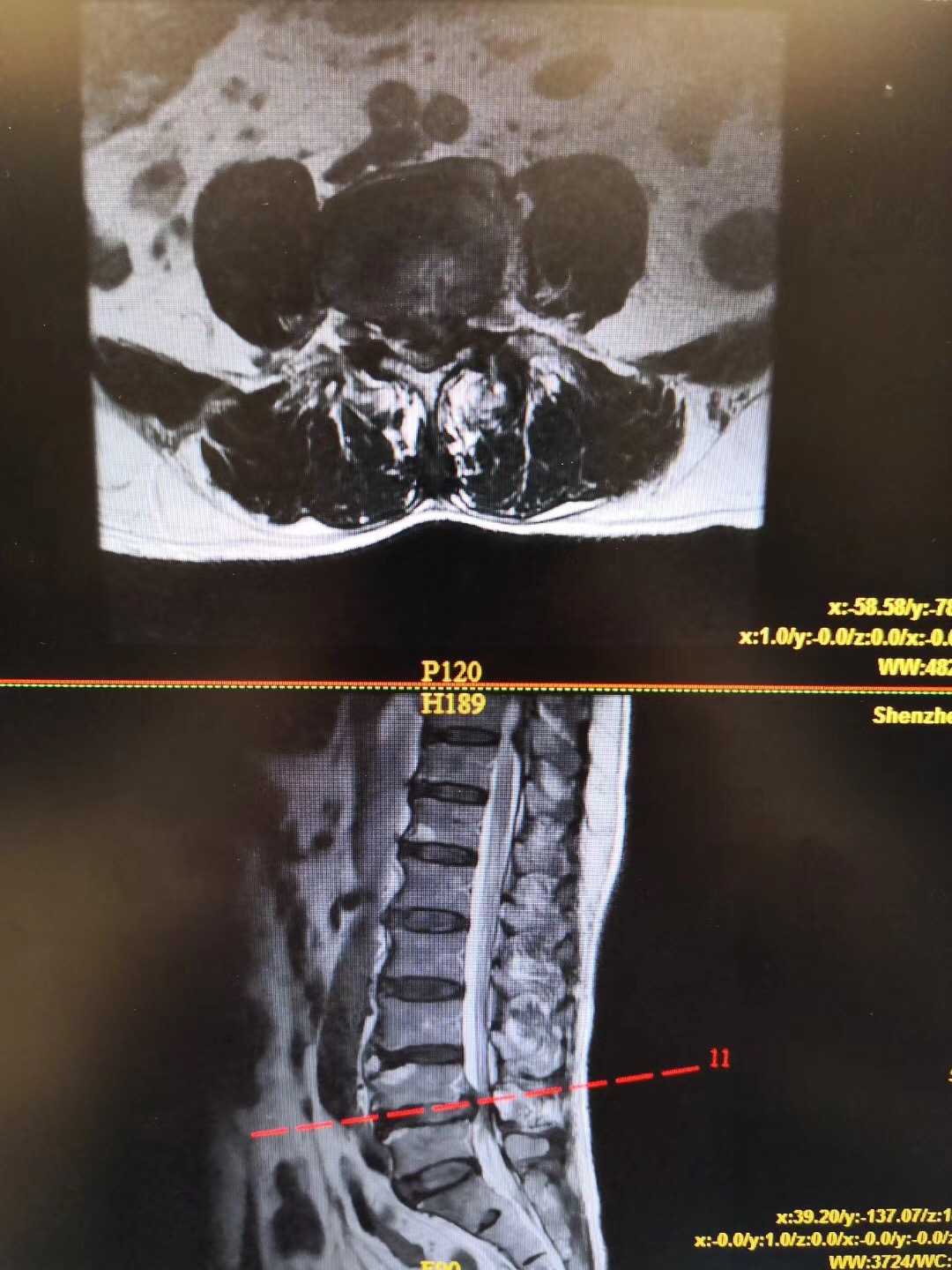 腰椎間盤突出伴椎管狹窄症案例解析_l4/5