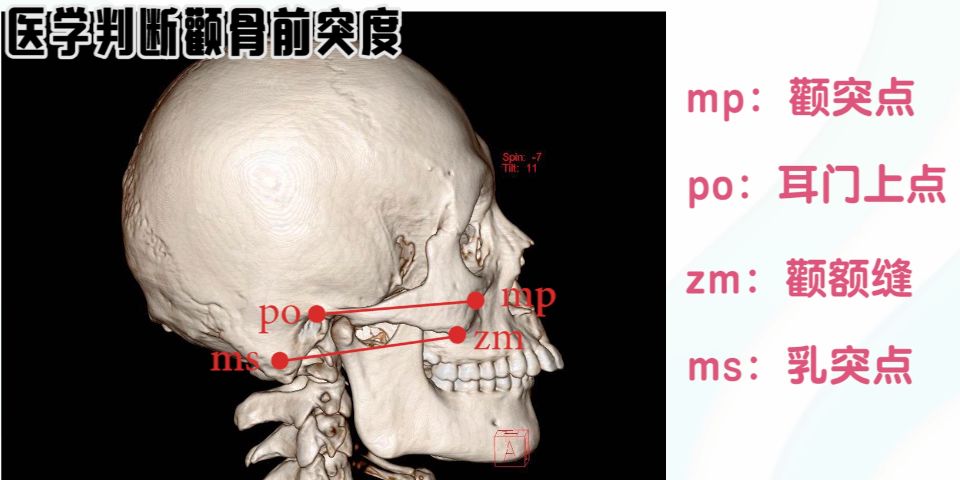 颧额缝点(zm)至乳突点的间距(ms),可分别代表颧骨和颧骨下缘的突度