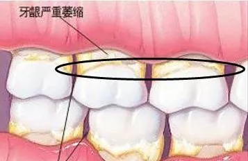 10箇中年人6個已缺牙別等到牙齦萎縮再後悔