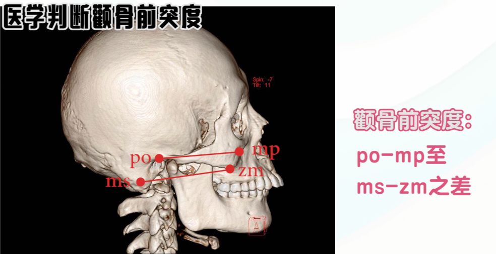 下颌切迹位置图片图片