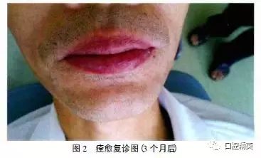 急性深部化脓型腺性唇炎1例