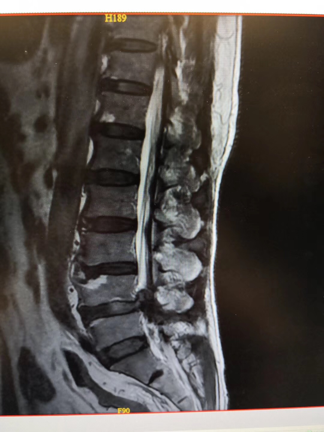 腰椎间盘突出伴椎管狭窄症案例解析