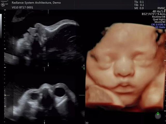 胎儿24周四维彩超图图片