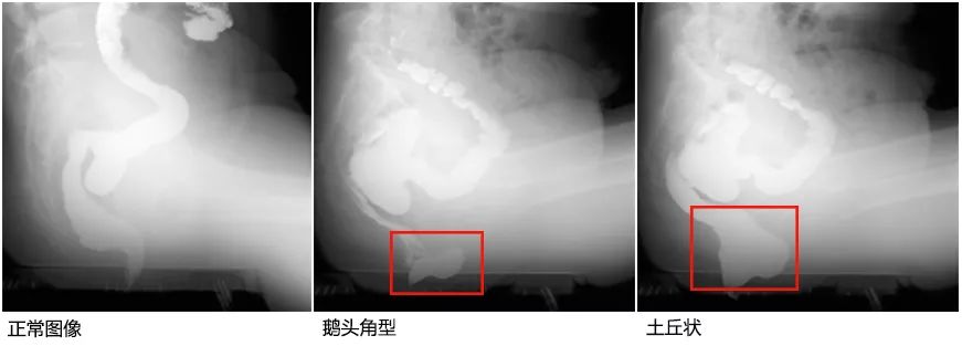 阴道因胎儿经阴道分娩时,直肠壁部分肌纤维组织会失去张力或发生松弛