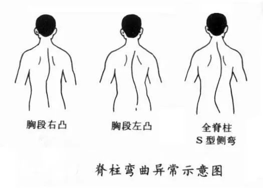 腰椎右侧弯示意图图片
