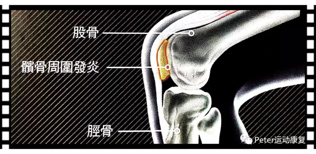 髕股疼痛綜合徵 ,髕前滑囊炎,滑膜炎,脛骨結節骨軟骨炎,髕下脂肪墊