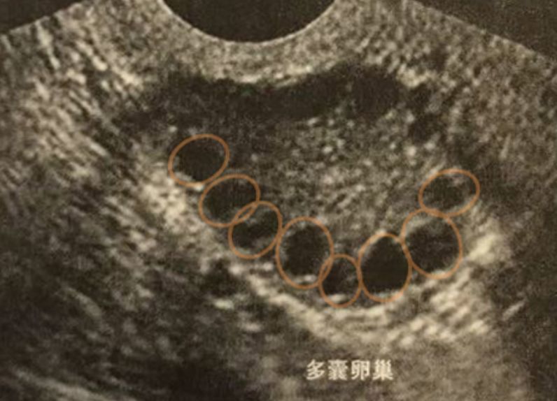 多囊卵巢b超怎么显示图片