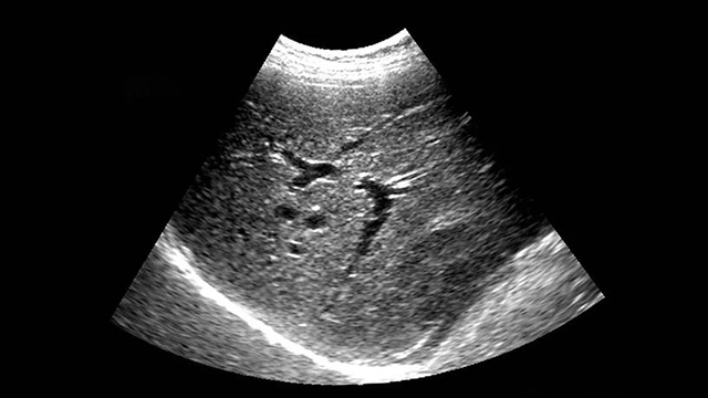 脂肪肝声像图改变图片