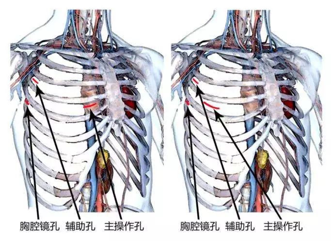 手術如期順利進行整個手術過程除了建立體外循環需要的操作孔外僅有一