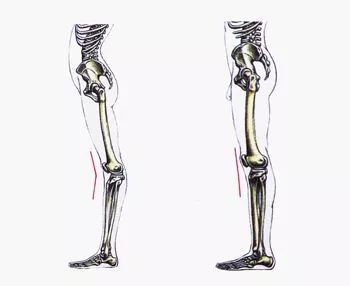 膝过伸—超经典病因机制及治疗方法总结_膝关节
