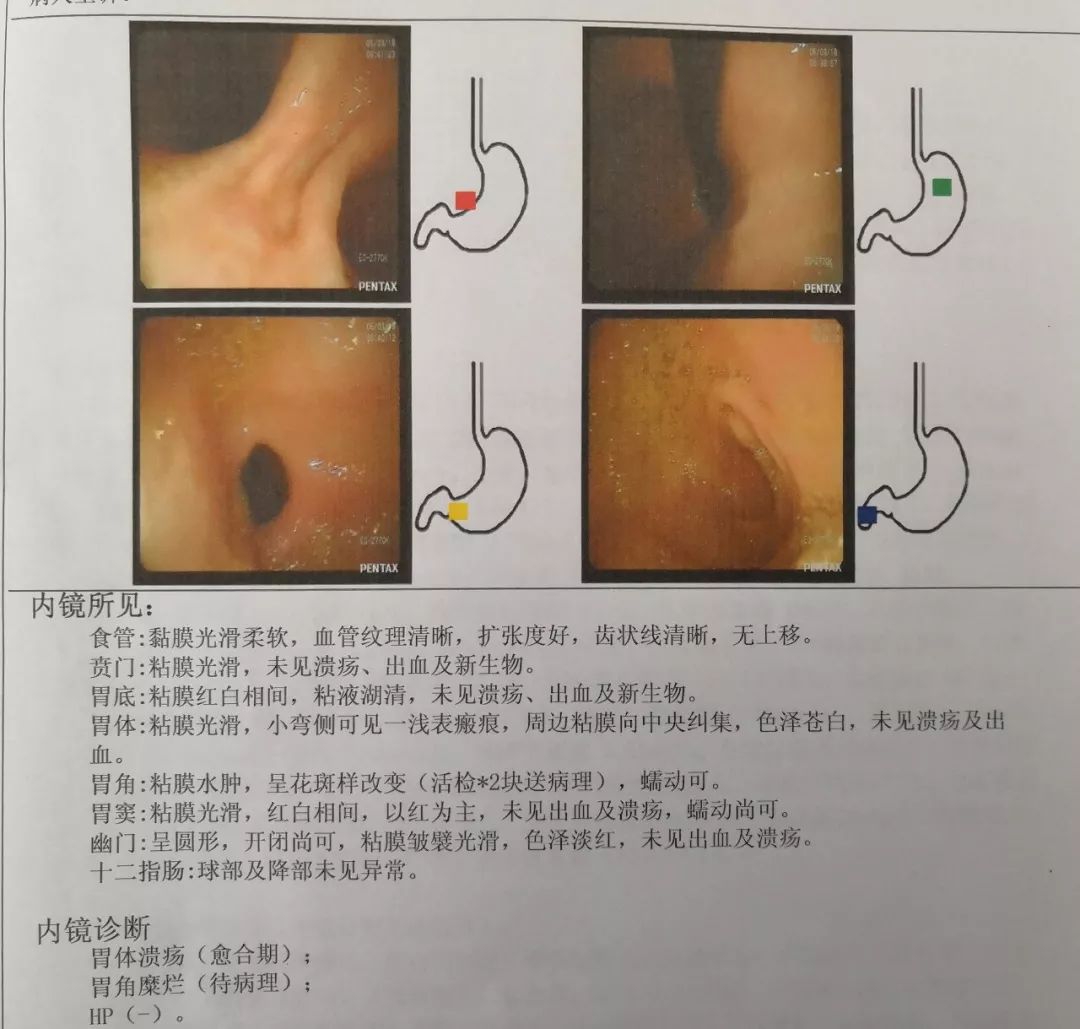 胃镜检查报告单高清图片