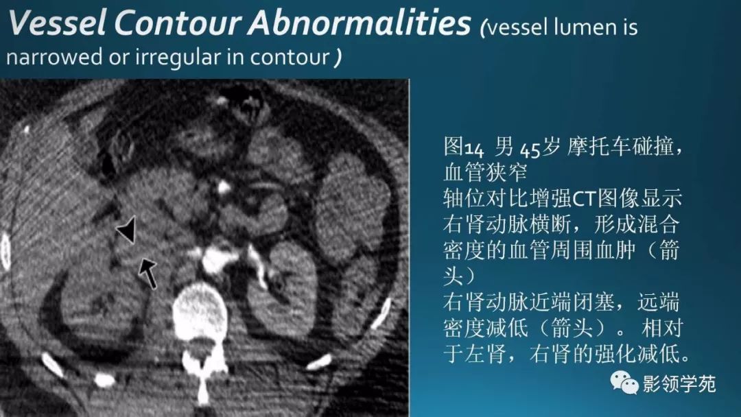 ct在腹盆部鈍性創傷中重要血管損傷的表現及應用