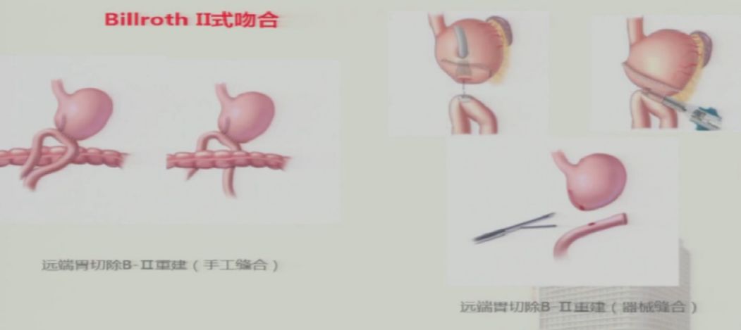 毕二式吻合图解输入袢图片