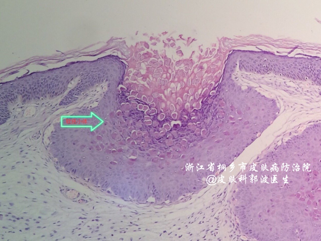 软疣小体镜下图片图片