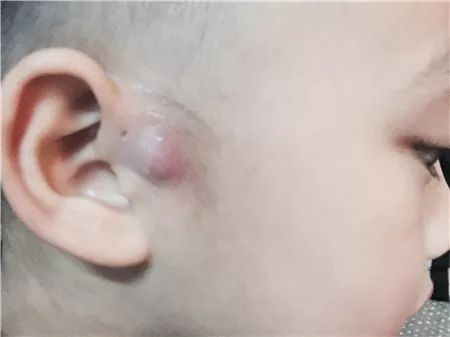 先天性耳前瘘管严重吗是怎么形成的呢