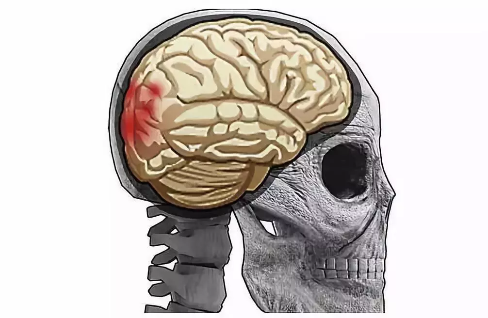 在吸毒的过程中,吸毒者的大脑功能已经发生改变,毒品之所以让人产生