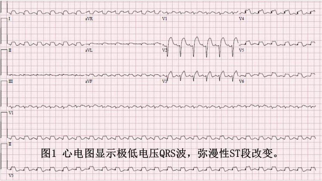 儿童心肌炎心电图图片