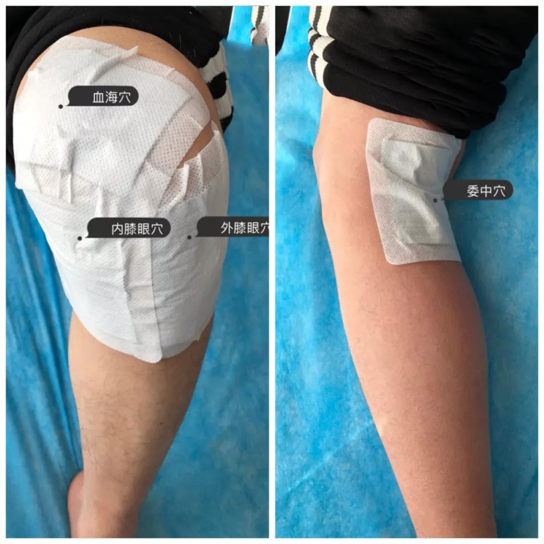 膝关节炎—膏药的正确贴法