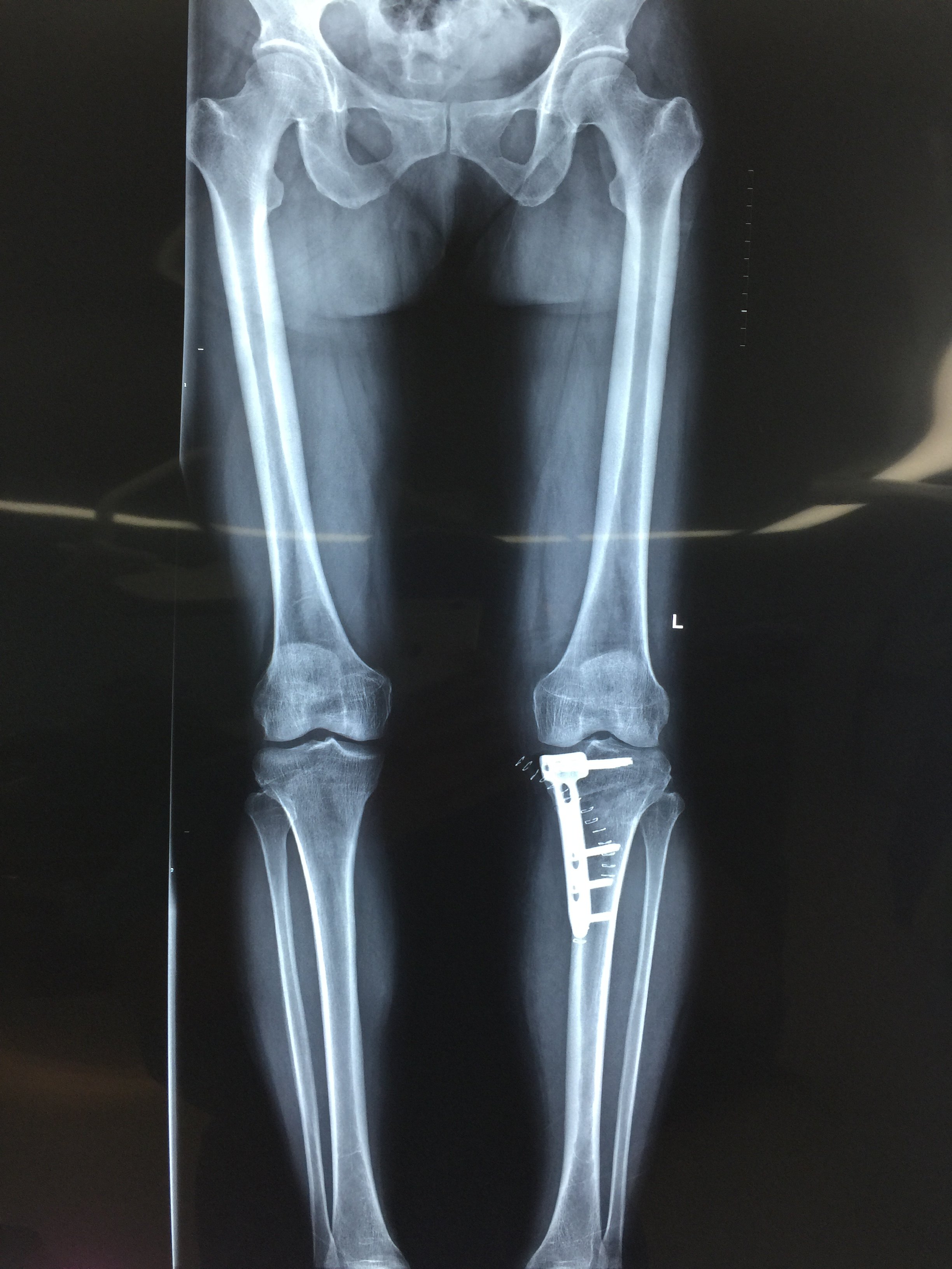 o形腿胫骨高位截骨 完美矫正畸形