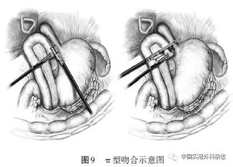 食管空肠吻合术示意图图片