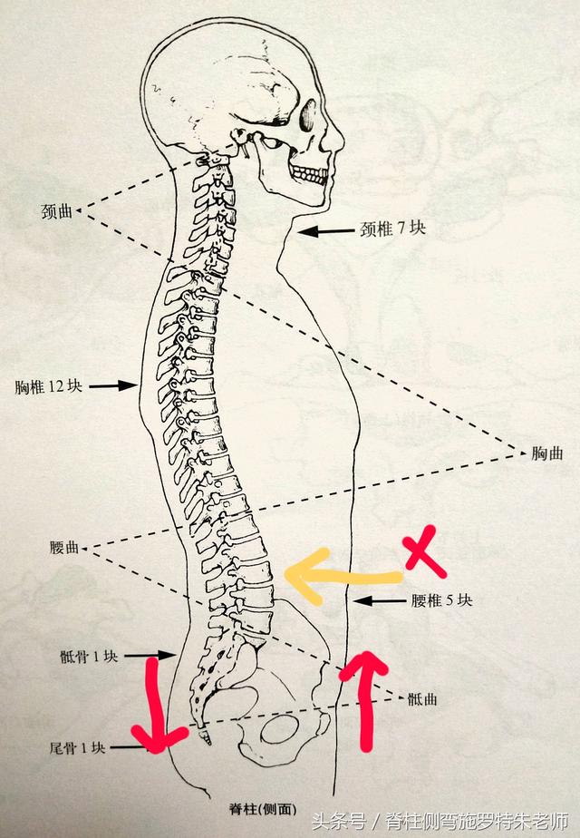 案例分析骨盆前倾是因为腰椎曲度过大吗