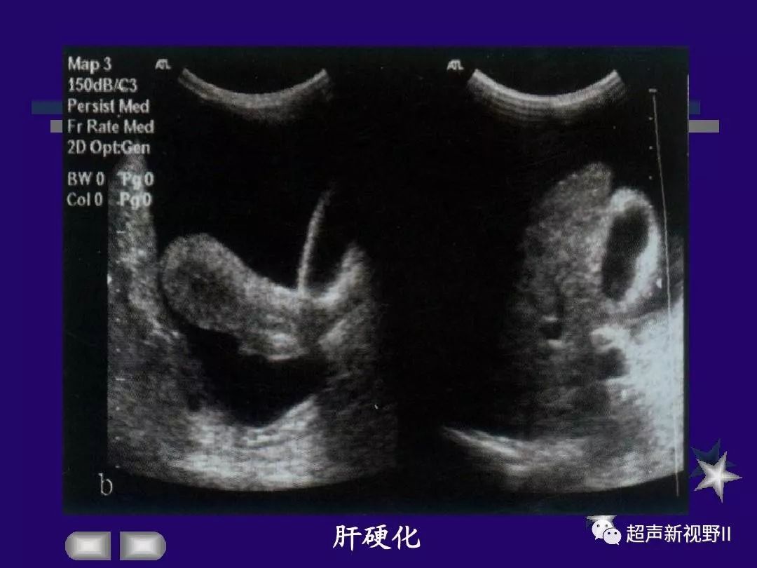 肝硬化声像图五大特点图片