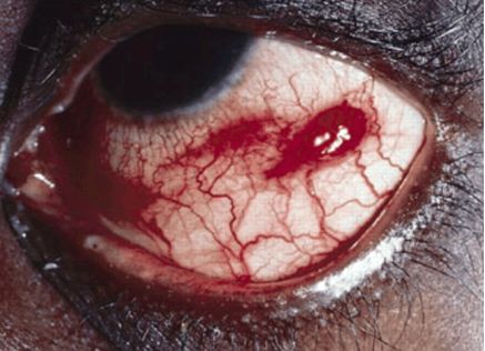 艾滋病的眼部早期症状图片