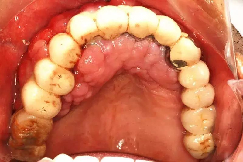 牙龈出血区分白血病图片