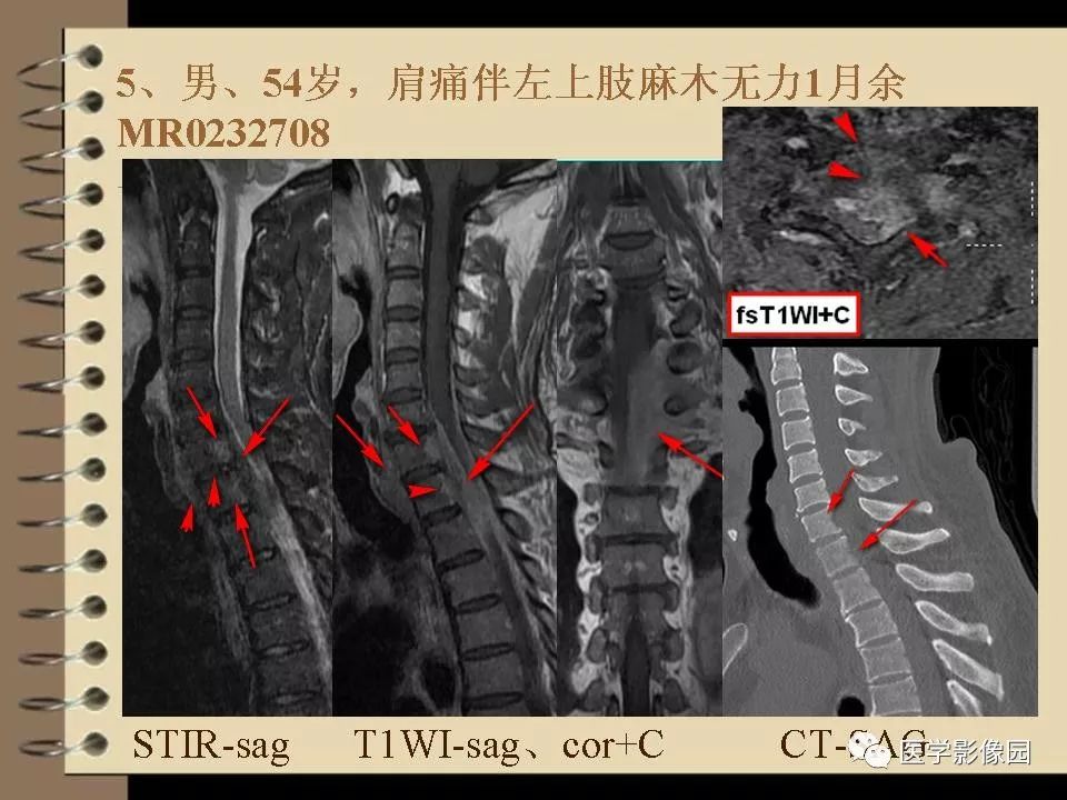 脊柱原发性恶心淋巴瘤的影像诊断 