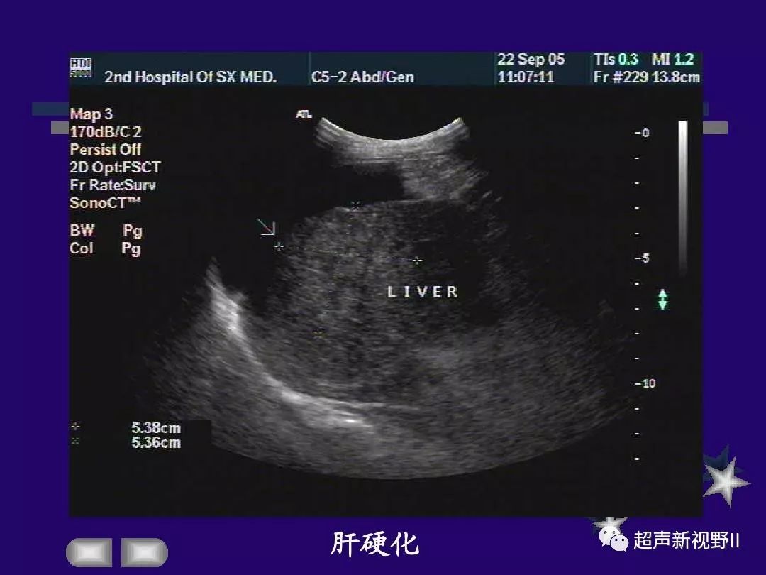 肝硬化声像图表现图片