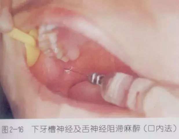 牙齿打麻药的位置图图片