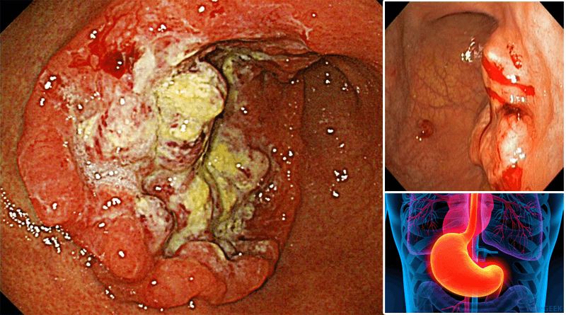 胃癌图片和胃糜烂图片图片