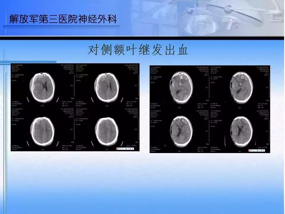 双额叶脑挫裂伤诊治中的一点思考丨颅脑创伤神经重症病例周刊94期