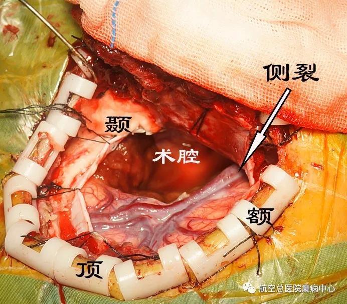 开颅手术的图片全过程图片