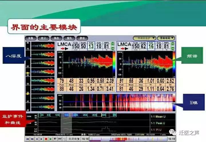 發泡試驗方法:使用經顱多普勒超聲血流分析儀,經雙通道多深度並在m