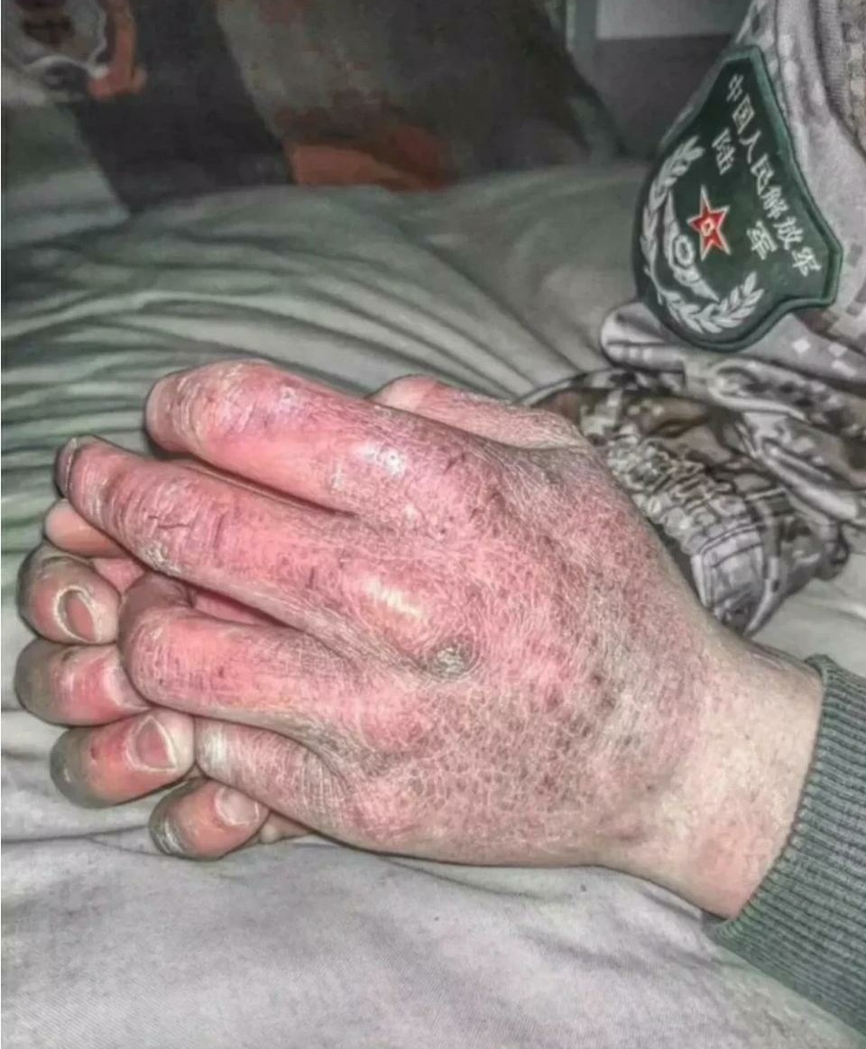 边防战士受伤的手图片图片