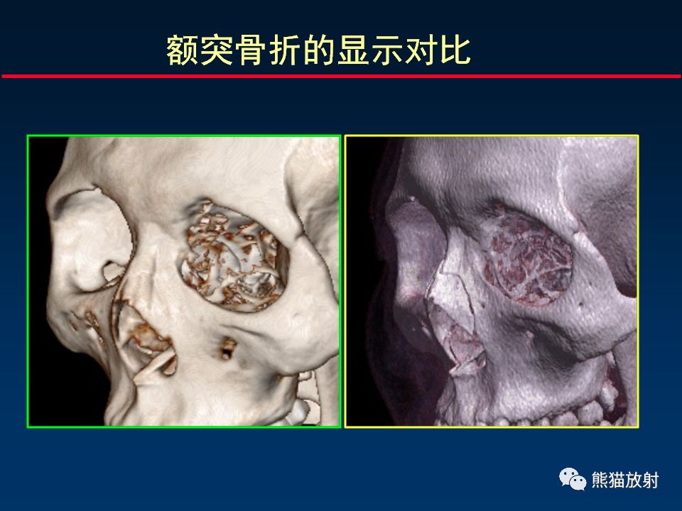 【柳澄讲坛】颌面外伤丨ct评价要点