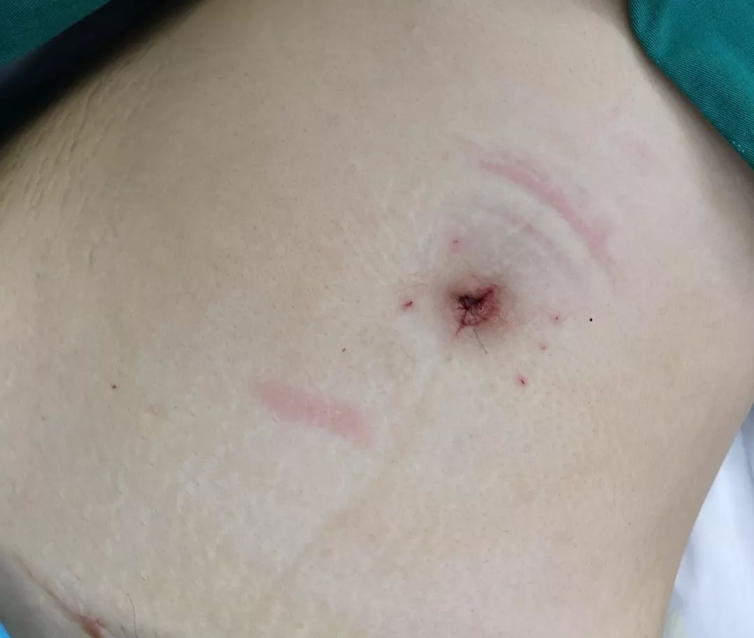 腹腔镜手术后疤痕图片