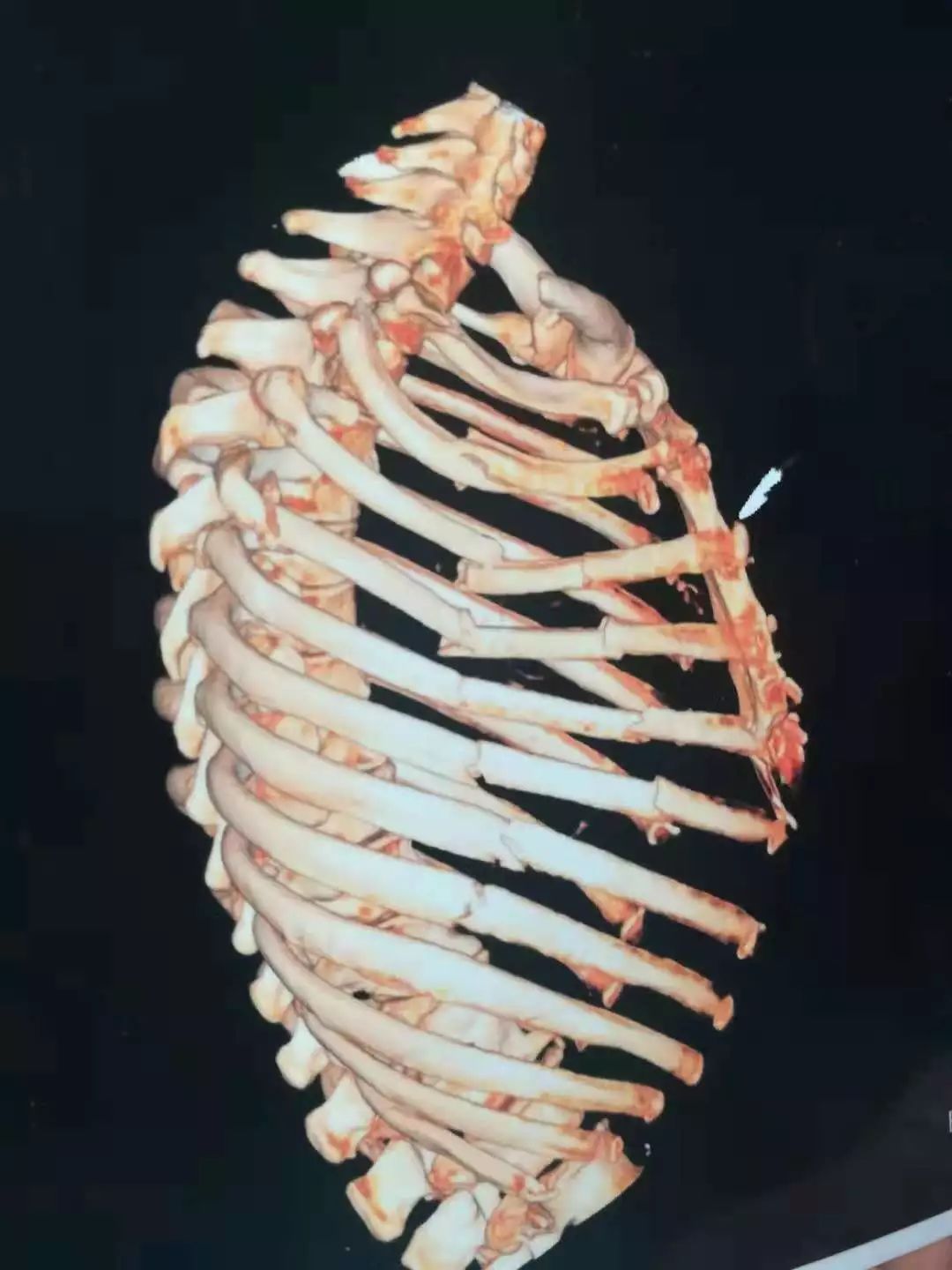 被送到我院急诊治疗,医生经过胸部ct检查发现患者右侧多发肋骨骨折(1