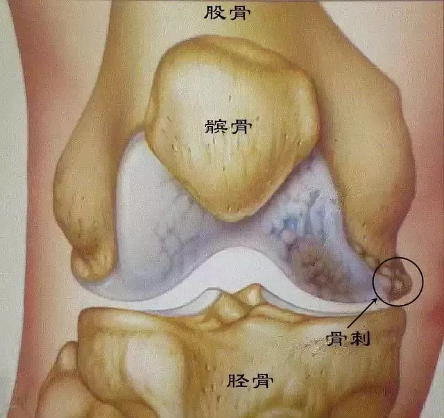 骨刺长在哪里图片图片