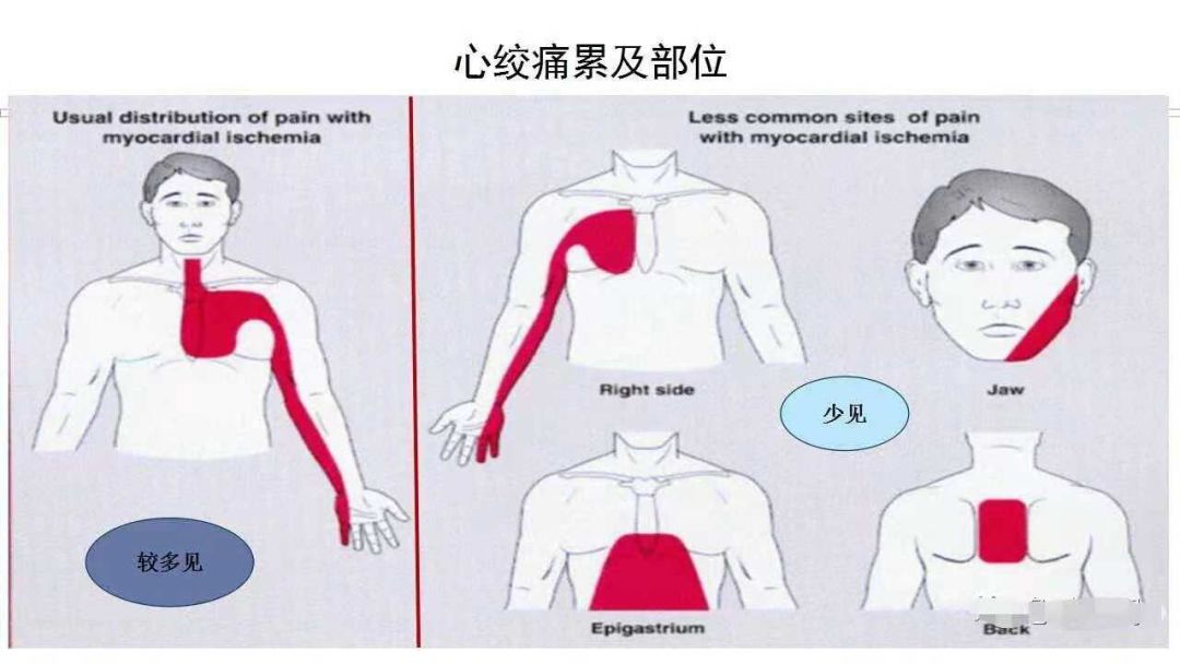 心肌缺血胸痛位置图图片